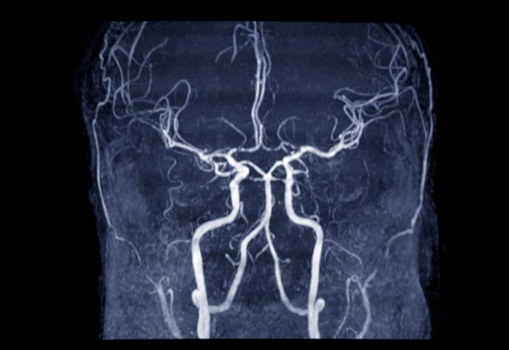 National Stroke Awareness Month 2021